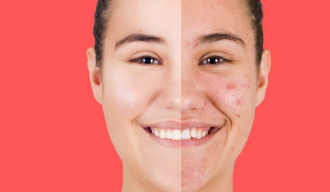 El acné y su impacto en la calidad de vida